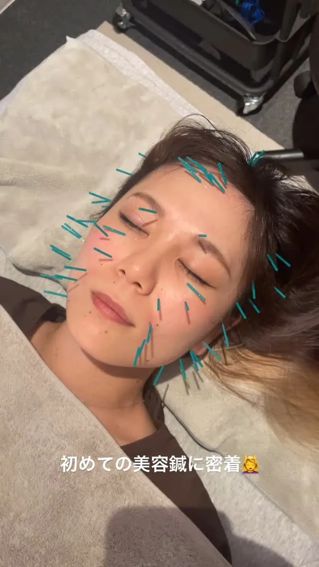 ＼ はじめての美容鍼に密着 💆‍♀️ ／